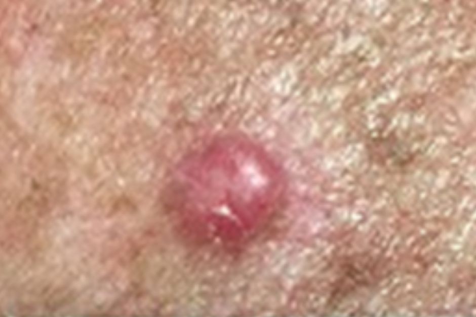 Basal cell carcinoma (BCC)