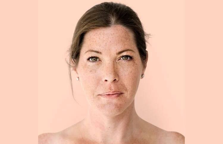 Melanoma
