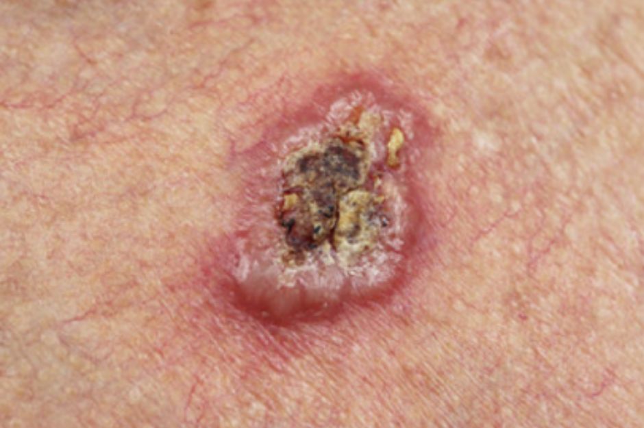 Squamous cell carcinoma (SCC)