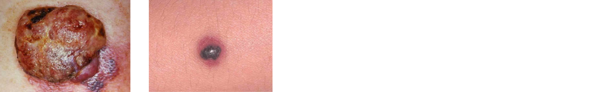 nodular