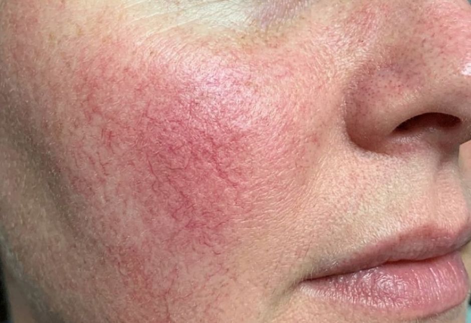 Gentle skincare treatment for mild rosacea including azelaic acid and metronidazole