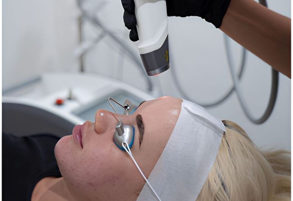LED light therapy and chemical peel treatment for moderate acne
