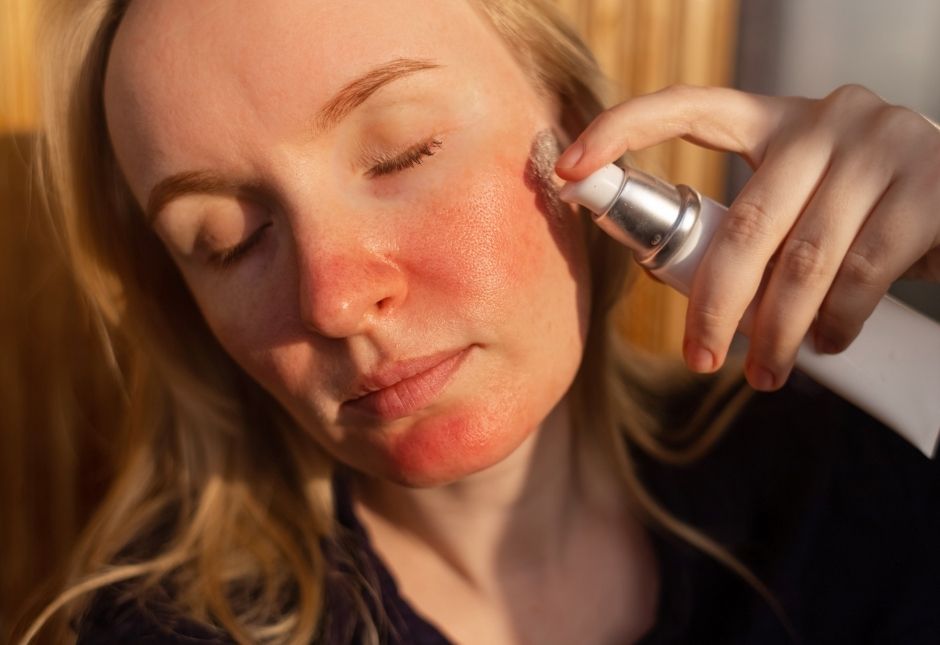 IPL and vascular laser treatment for moderate rosacea