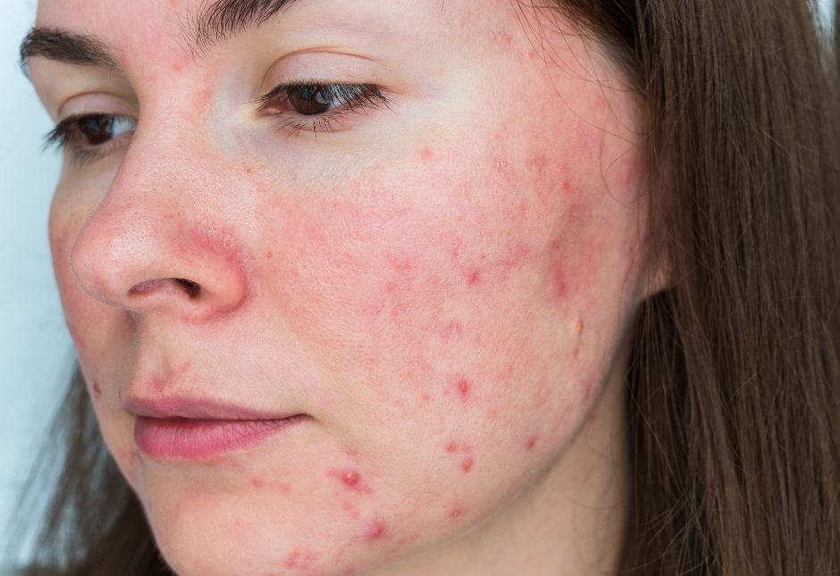 Advanced vascular laser and clinic treatment for moderate to severe rosacea