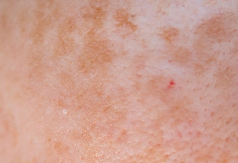 Illustration of blood vessel reactivity and inflammation underlying rosacea