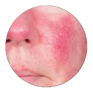 Erythematotelangiectatic rosacea (ETR)