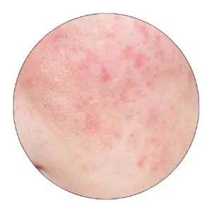 Papulopustular rosacea (PPR)