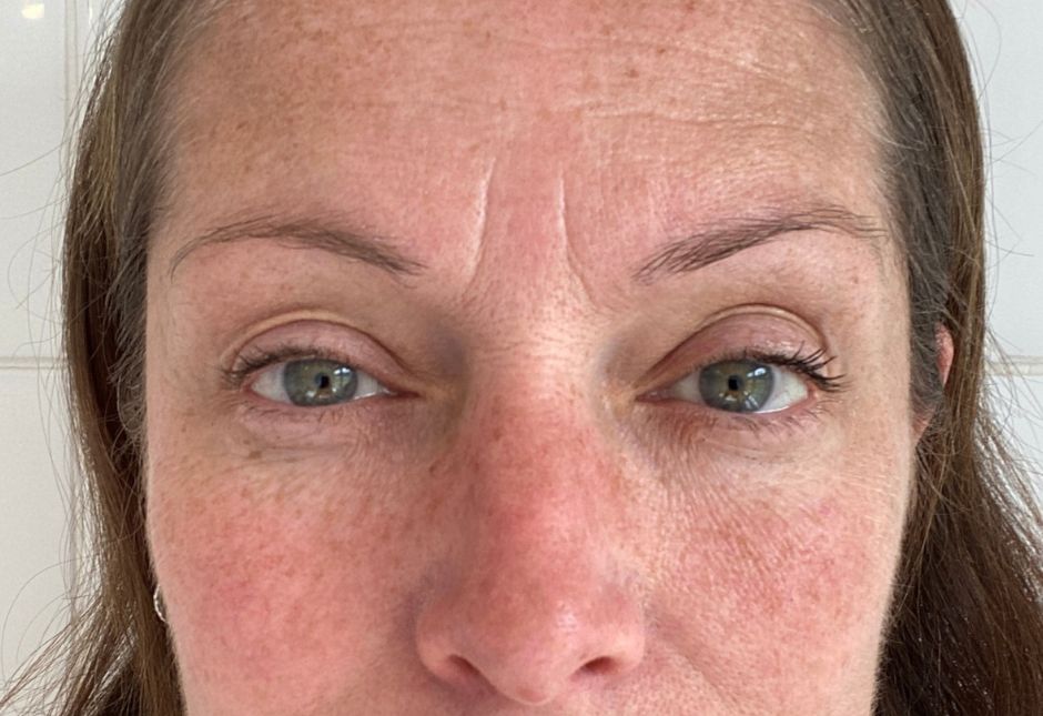 Facial melasma with symmetrical brown pigmentation and redness across the cheeks and nose