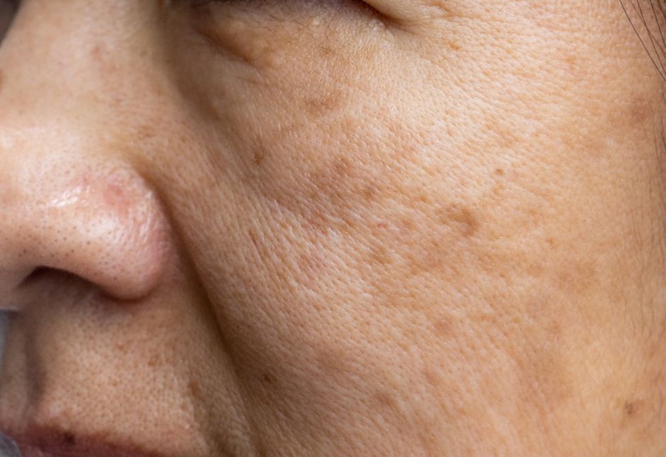 Close-up of facial pigmentation with uneven brown patches and sun-related pigmentation on the cheek