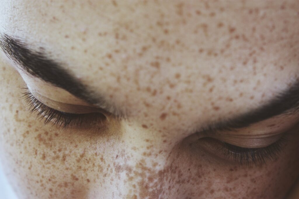 Close-up of facial pigmentation and melasma showing brown patches and freckles around the eyes and cheeks.