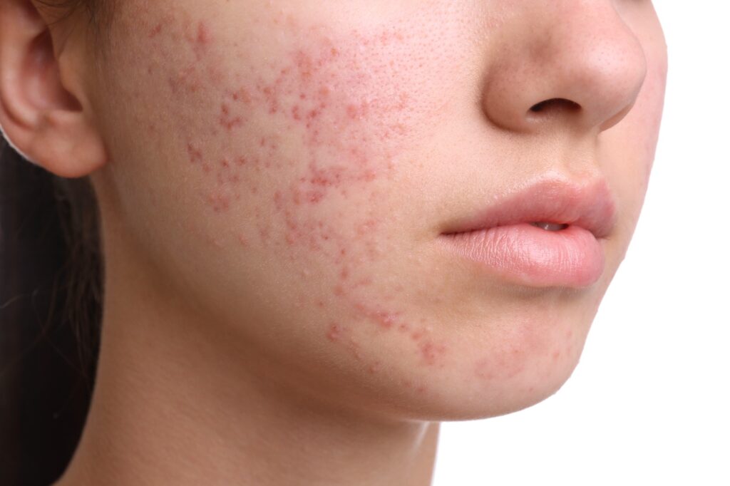 inflammatory-acne-cheek