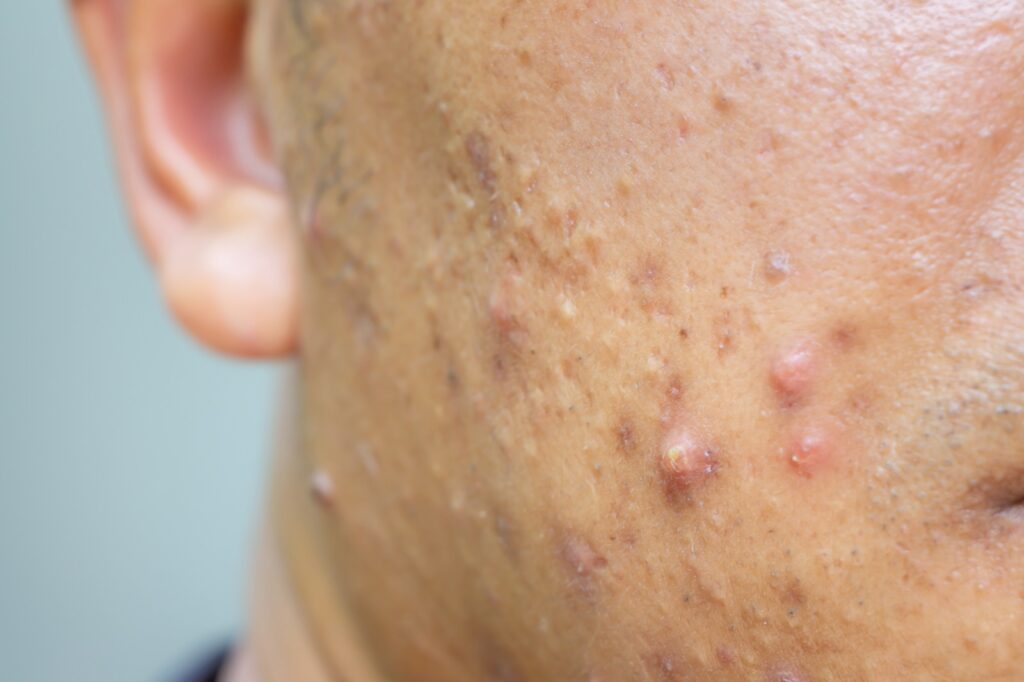 inflammatory-acne-deeper-skin-tone