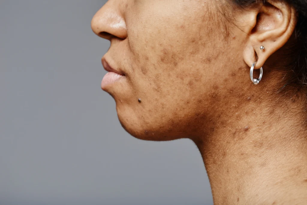 Side profile showing facial post-inflammatory hyperpigmentation with uneven brown pigmentation on the cheek and jawline