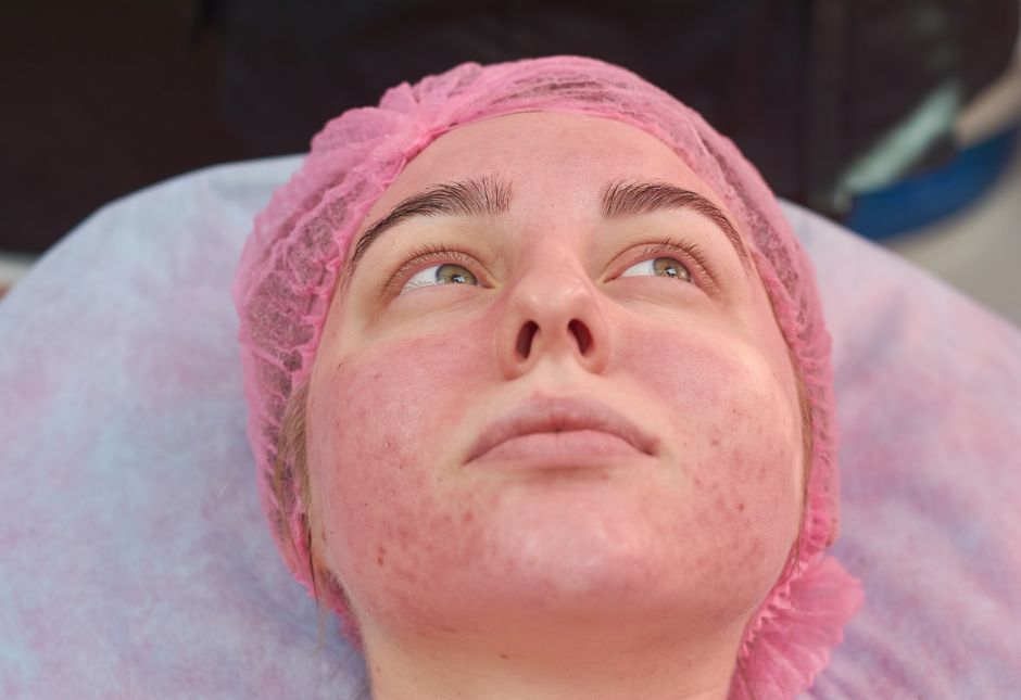 Facial redness and visible inflammation affecting the cheeks and chin in rosacea