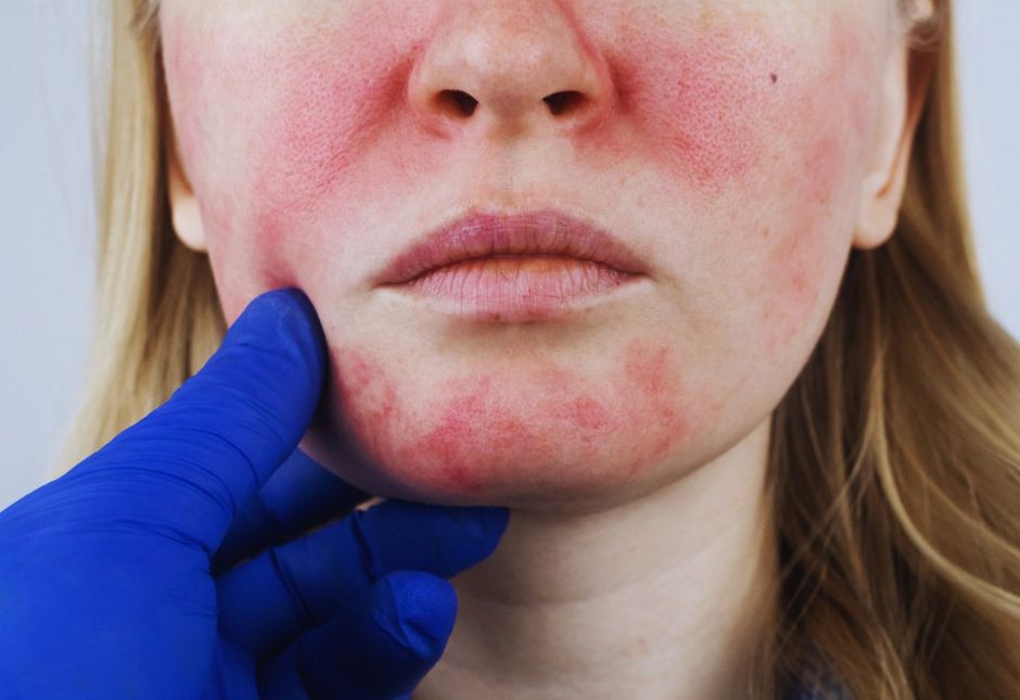 Facial redness and inflammatory changes associated with rosacea