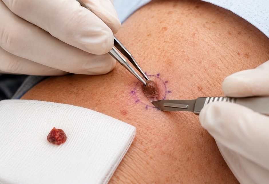 skin-biopsy-dermatology-procedure